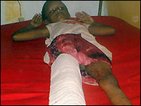 Wounded girl in Mogadishu